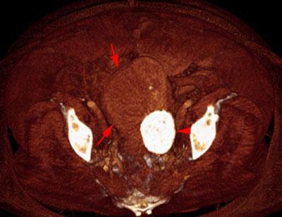 Mioma uterino calcificado