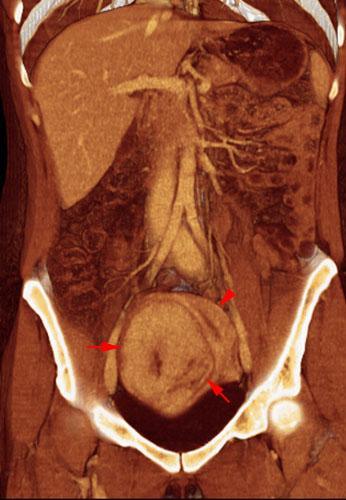 Mioma uterino 