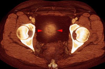 Mioma uterino 