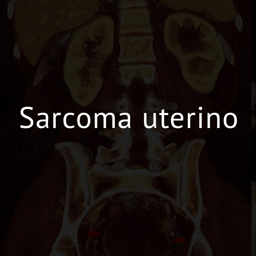 Sarcoma uterino