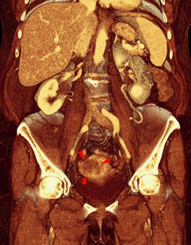 Tumor de endometrio 1