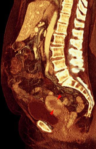 Tumor de endometrio 1