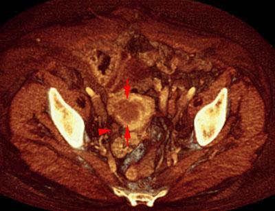 Tumor de endometrio 1