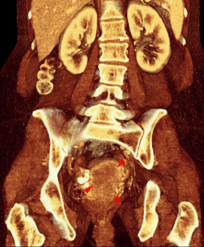 Tumor de endometrio 2