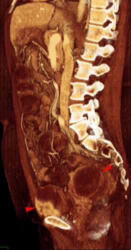 Sarcoma uterino