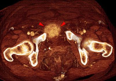 Sarcoma uterino