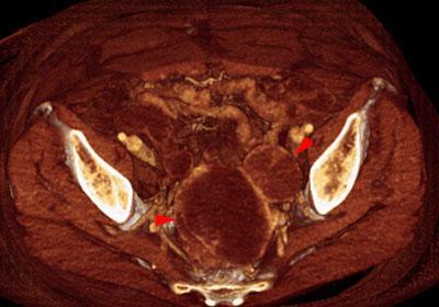 Sarcoma uterino