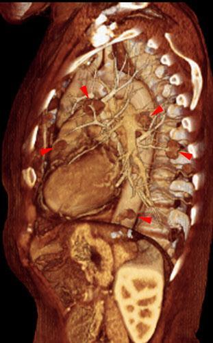 Recidiva y metástasis de neo de endometrio
