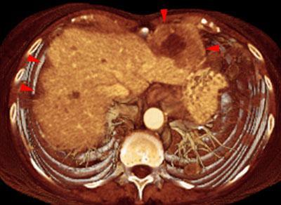 Recidiva y metástasis de neo de endometrio