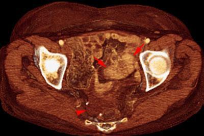 Recidiva y metástasis de neo de endometrio