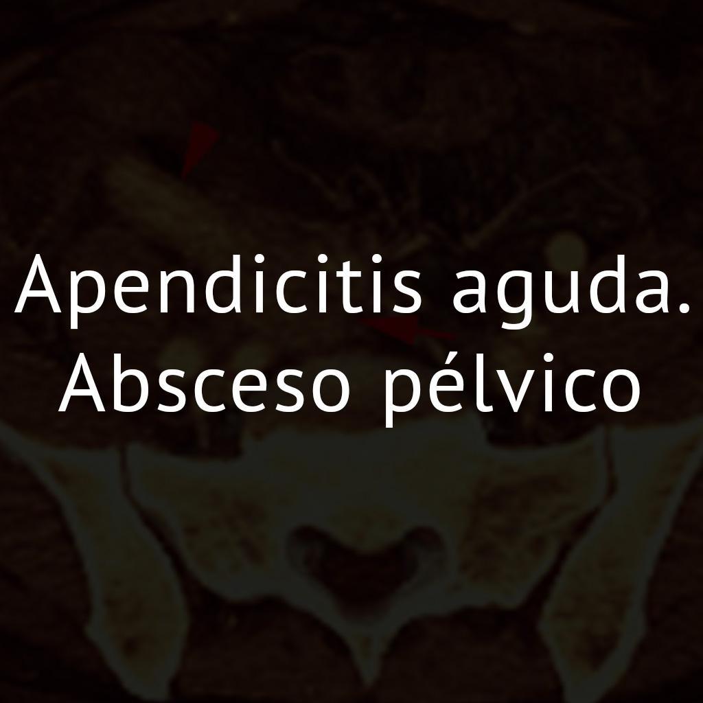 Apendicitis aguda. Absceso pélvico