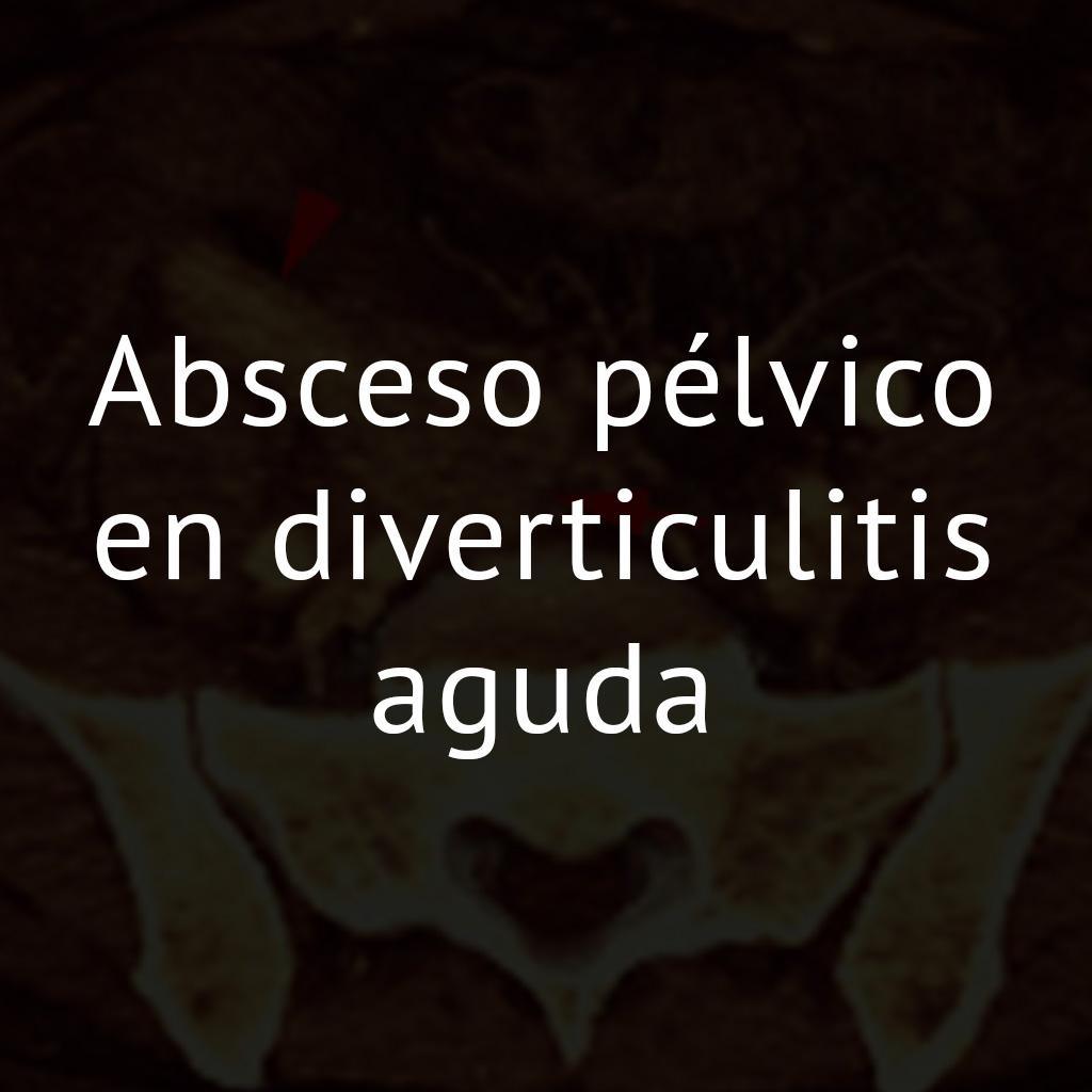 Absceso pélvico en diverticulitis aguda