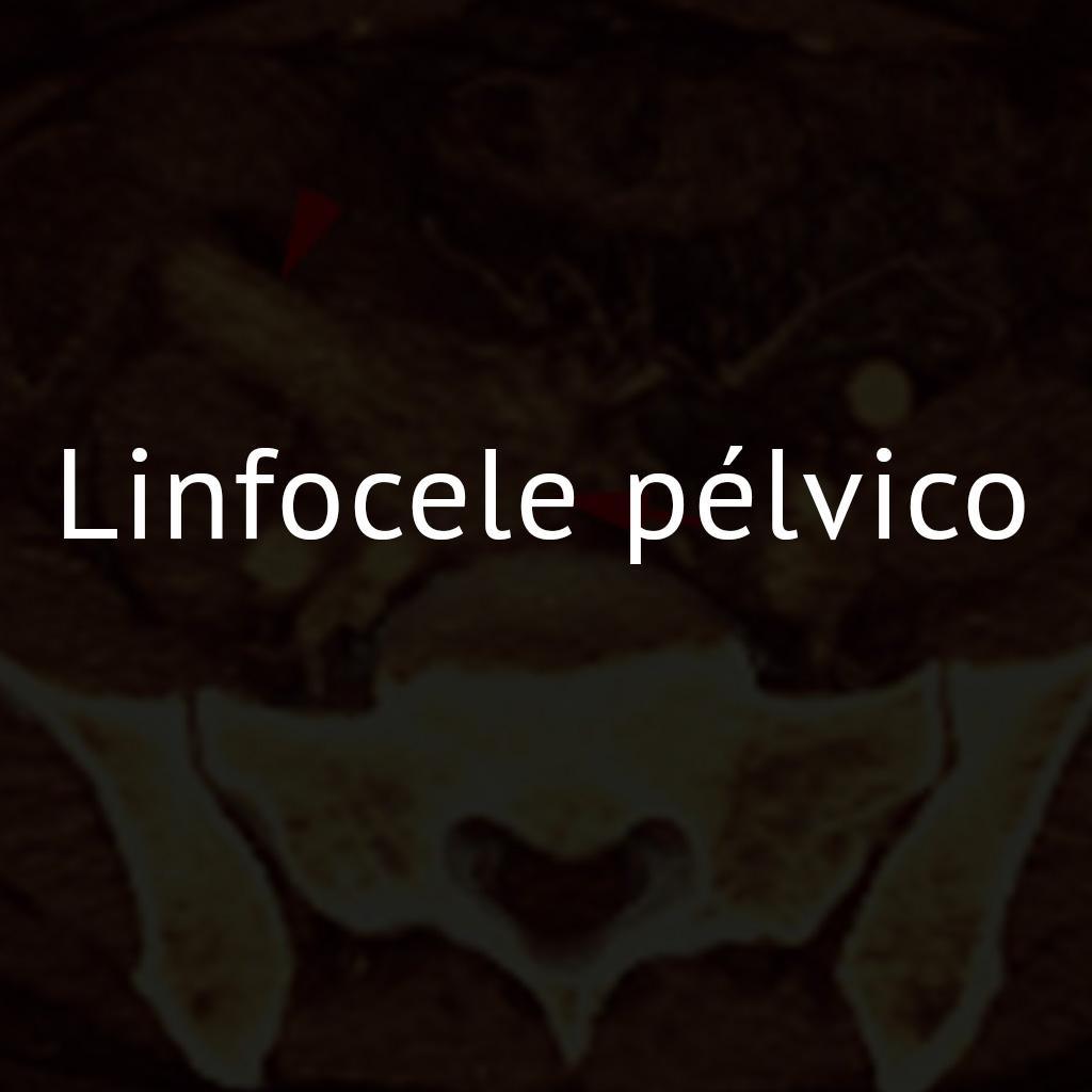 Linfocele pélvico