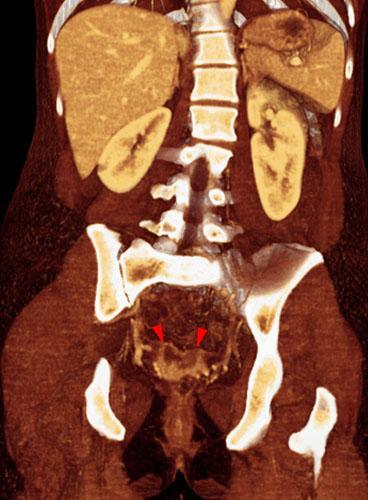 Absceso en cúpula vaginal post histerectomía