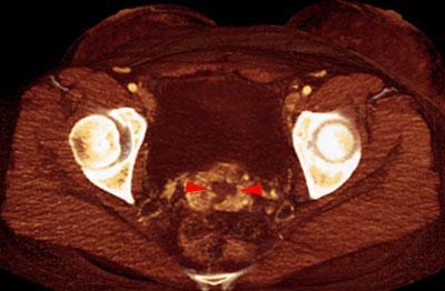 Absceso en cúpula vaginal post histerectomía