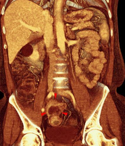 Apendicitis aguda. Absceso pélvico