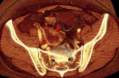 Apendicitis aguda. Absceso pélvico