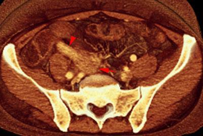 Apendicitis aguda. Absceso pélvico