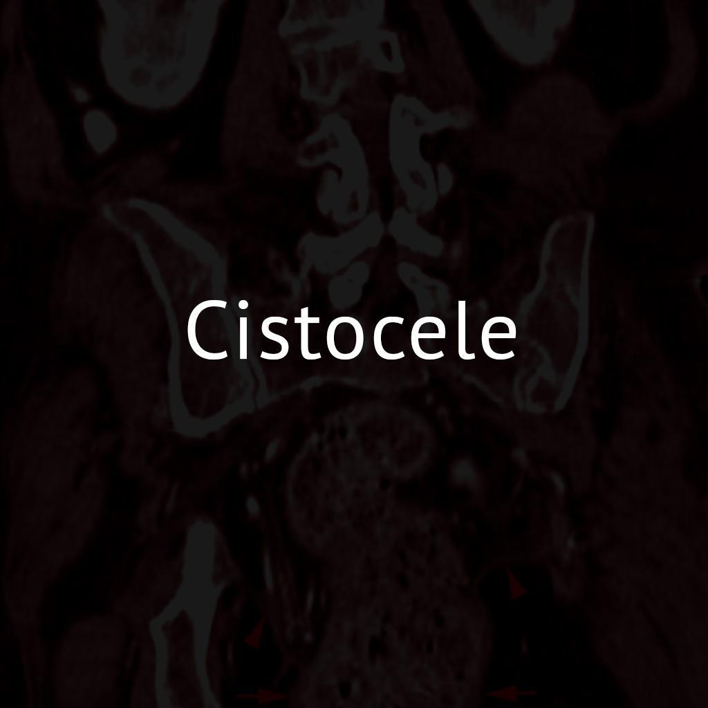 Cistocele