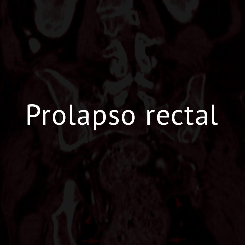 Prolapso rectal