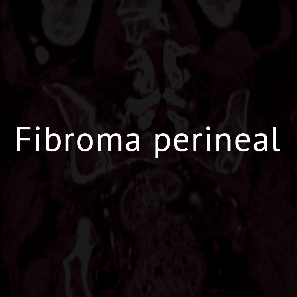Fibroma perineal