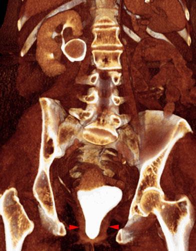 Cistocele