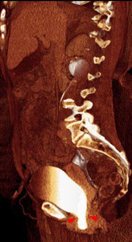 Cistocele