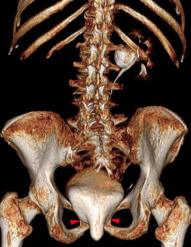 Cistocele