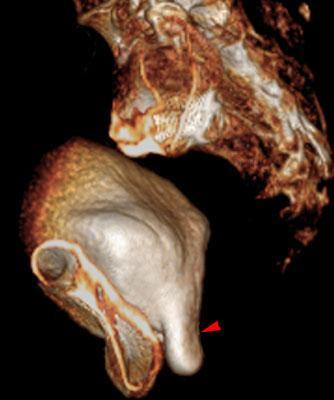 Cistocele