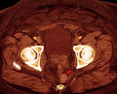 Fibroma perineal