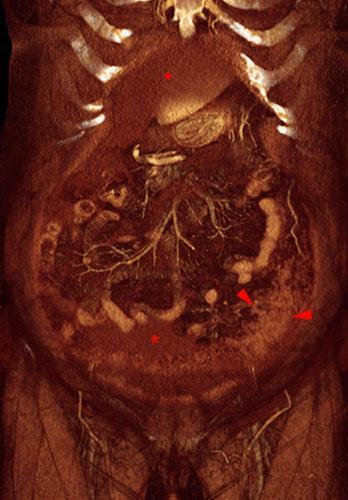 Carcinoma de ovario. Omental cake