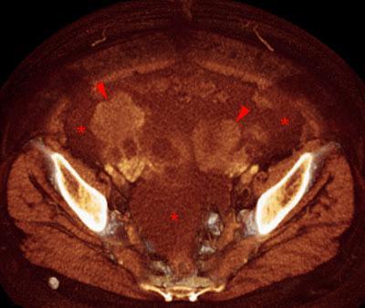Carcinoma de ovario. Omental cake