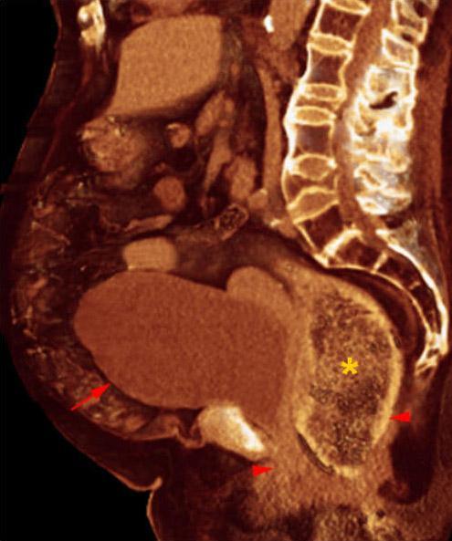 Prolapso rectovaginal 2