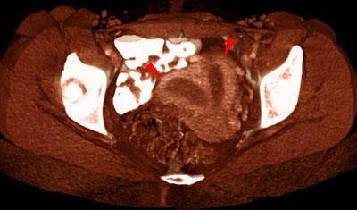 Duplicidad uterina