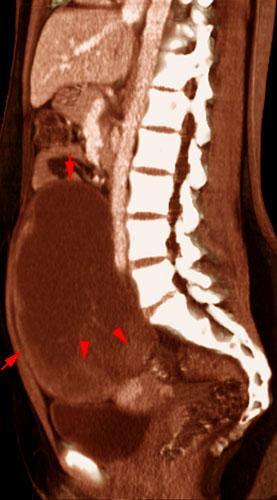 Carcinoma de ovario