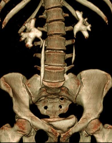 Carcinoma de ovario