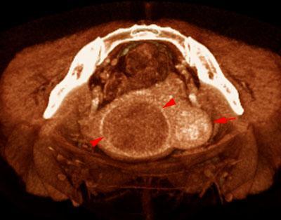 Miomatosis uterina
