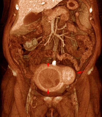 Miomatosis uterina