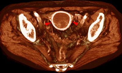 Sarcoma de bajo grado uterino