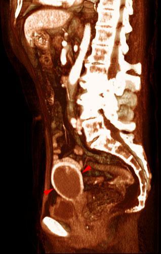Sarcoma de bajo grado uterino