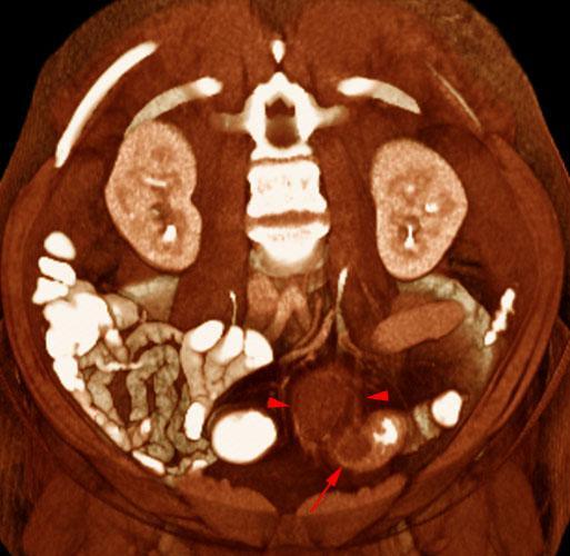 Absceso pélvico en diverticulitis aguda