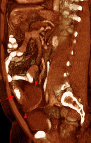 Absceso pélvico en diverticulitis aguda