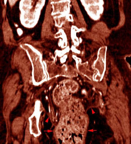 Prolapso rectal