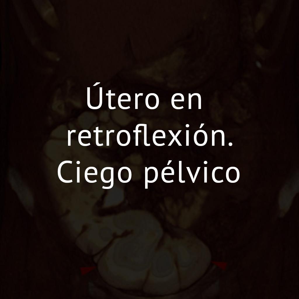 Útero en retroflexión. Ciego pélvico