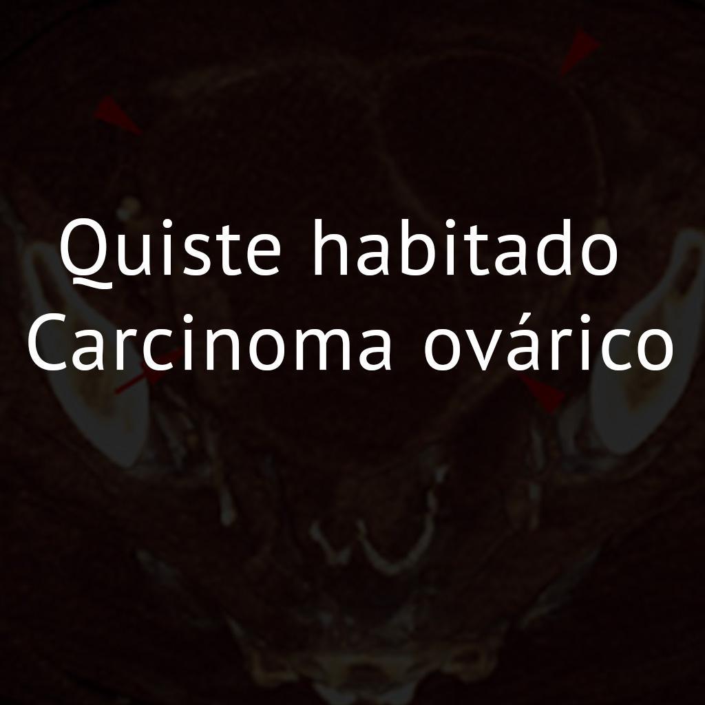 Quiste habitado Carcinoma ovárico