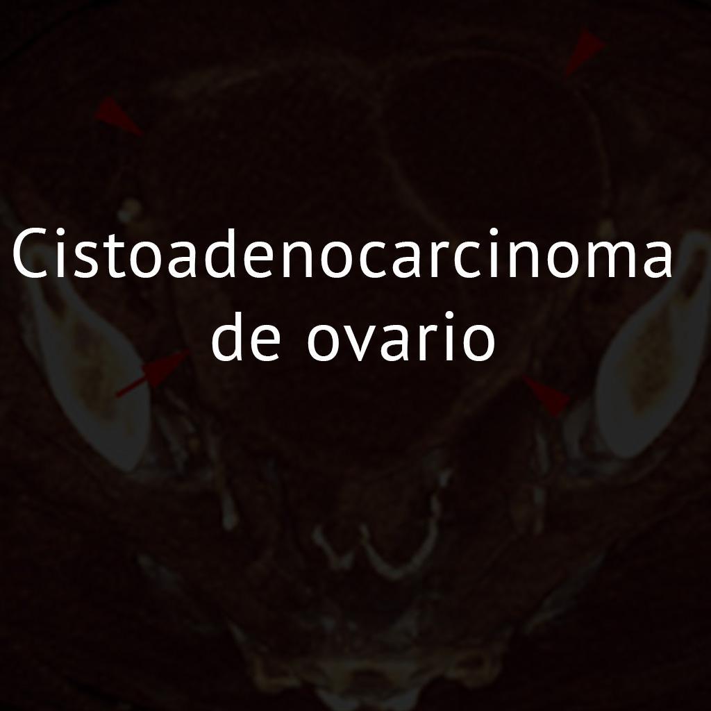 Cistoadenocarcinoma de ovario