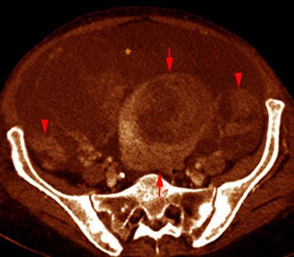 Carcinoma de ovario. Ascitis 