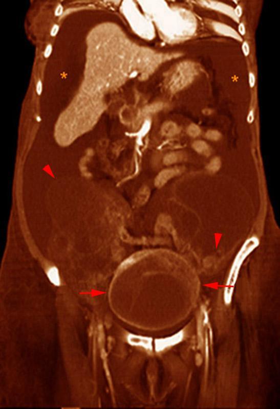 Carcinoma de ovario. Ascitis 