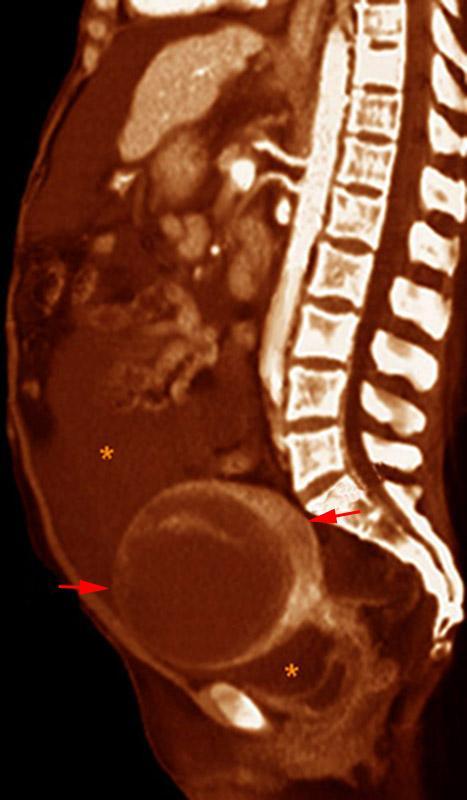 Carcinoma de ovario. Ascitis 