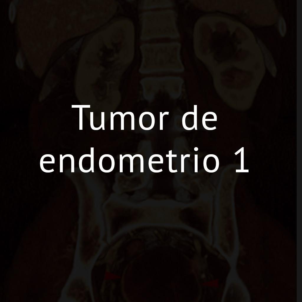 Tumor de endometrio 1